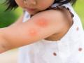 Trẻ em mắc sốt xuất huyết hạ sốt vẫn có thể diễn biến nặng