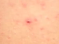 Ba người tử vong do virus Hanta, Bộ Y tế khuyến cáo 5 biện pháp phòng bệnh