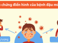 Bệnh đậu mùa khỉ: Triệu chứng và phòng tránh