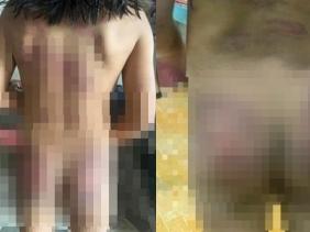 Nghi án bé gái ở Bình Phước bị bạo hành: Vết thương khắp cơ thể