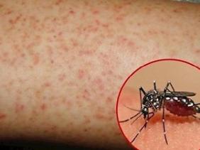 7 dấu hiệu cảnh báo sốt xuất huyết tăng nặng cần đến bệnh viện ngay