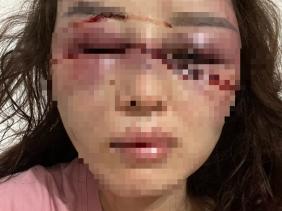 Vụ cán bộ QLTT bị tố đánh đập, lột đồ người tình: Nạn nhân vừa trải qua 3 tiếng phẫu thuật