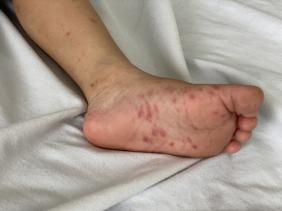Dấu hiệu bệnh tay chân miệng trở nặng