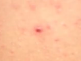 Ba người tử vong do virus Hanta, Bộ Y tế khuyến cáo 5 biện pháp phòng bệnh