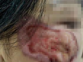 Loét cả mảng da mặt vì dùng thuốc chứa axit để trị nám