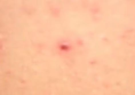 Ba người tử vong do virus Hanta, Bộ Y tế khuyến cáo 5 biện pháp phòng bệnh