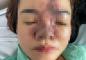 Tai biến thẩm mỹ khi đến spa làm đẹp, một phụ nữ bị hoại tử toàn bộ da mũi