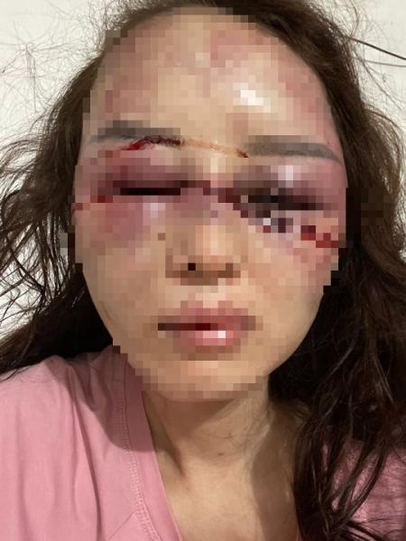 vu can bo qltt bi to danh dap lot do nguoi tinh nan nhan vua trai qua 3 tieng phau thuat vu can bo qltt bi to danh dap lot do nguoi tinh nan nhan vua trai qua 3 tieng phau thuat
